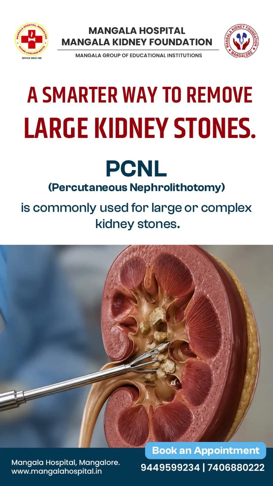 PCNL treatment for large or complex kidney stones